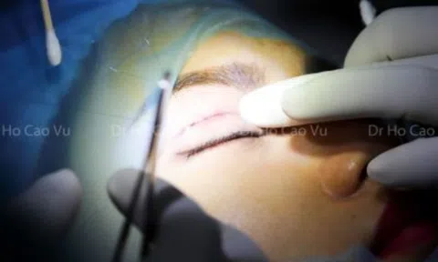 Bỏ túi loạt kinh nghiệm đi cắt mí mắt để có kết quả mỹ mãn, đảm bảo an toàn