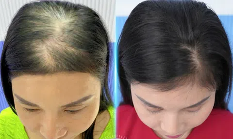 Tăng sinh mầm tóc Flori Hair – Công nghệ được hàng triệu khách hàng tin dùng