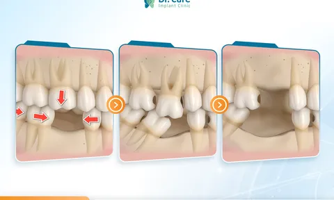 Mất răng số 7 và hậu quả khó lường! Trồng răng Implant số 7 giá bao nhiêu?