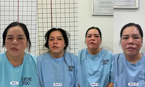 Hành trình phục hồi những ca lệch mặt nghiêm trọng tại iBONE FiSiO