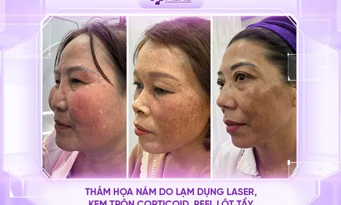 Chi hàng trăm triệu trị nám vẫn thất bại: Đâu là lối thoát cho những làn da “thảm hoạ nám”?