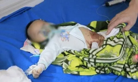 Bé 2 tháng tuổi nguy kịch vì gia đình đắp tỏi chữa Covid-19