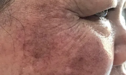 Thẩm mỹ viện trị nám uy tín tại Gia Lai