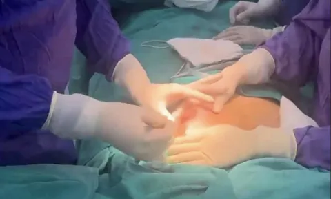 Áp xe ngực nghiêm trọng sau 5 năm tiêm chất làm đầy