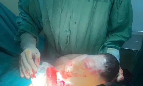 Hiếm gặp: Bé sơ sinh chào đời còn nguyên trong bọc ối