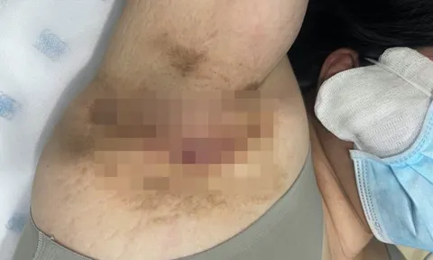Một phụ nữ thoát được căn bệnh "nhạy cảm" suốt 9 năm