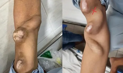 Cảnh báo suy thận ở người trẻ