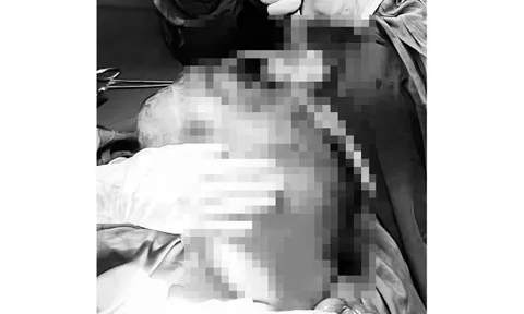 Thấy bụng to bất thường, người phụ nữ đi khám thì phát hiện điều bất ngờ