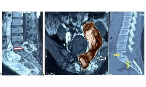 Người phụ nữ bị đau lưng, tê chân đến bệnh viện phát hiện điều bất ngờ