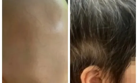 Bé gái 7 tuổi rụng tóc toàn đầu, hồi phục kỳ diệu sau một năm