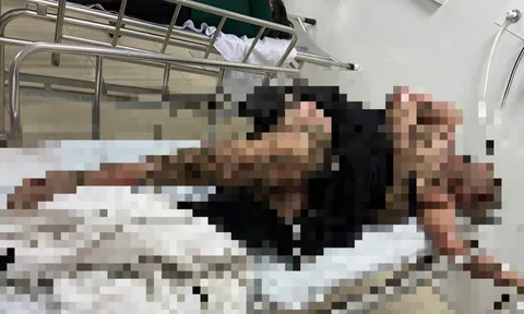 Bị bỏng toàn thân khi quăng câu vướng vào dây điện