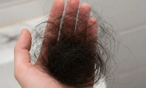 Rụng tóc ở người trẻ: Nguyên nhân phổ biến ít ai để ý