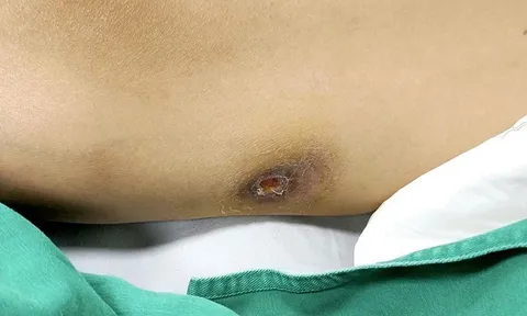 Bệnh Whitmore khiến nam 39 tuổi ở Thanh Hoá nguy kịch