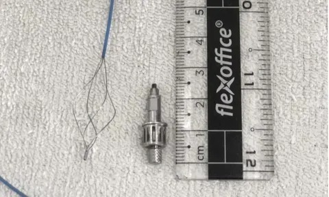 Sau trồng răng implant, bất ngờ phát hiện dị vật mắc trong phế quản