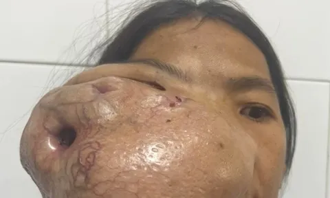 Người phụ nữ mang khối u khổng lồ trên mặt suốt nhiều năm