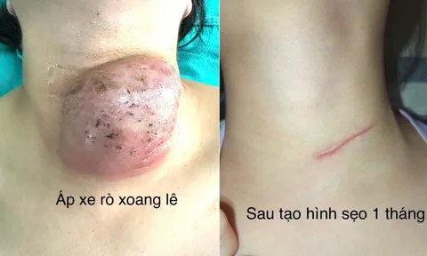 Phẫu thuật nội soi đóng rò xoang lê cho hàng chục trẻ em