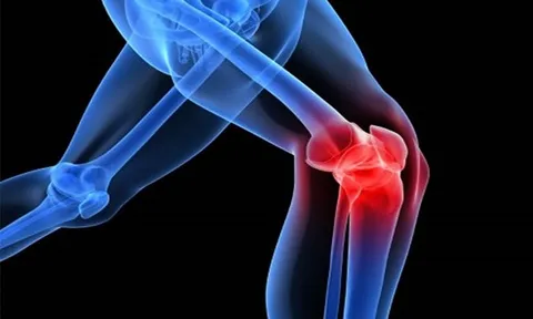 Bị thoái hóa khớp gối, tập thể dục sao cho phù hợp?