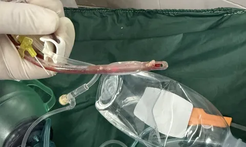 Bác sĩ cấp cứu đau lòng trước bé gái 3 tuổi sặc thức ăn ở nhà trẻ