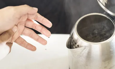 Bé 9 tháng tuổi bỏng 30% cơ thể do kéo dây nguồn ấm siêu tốc