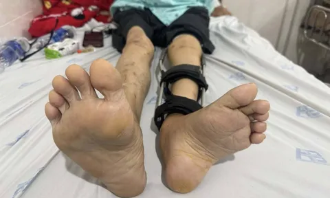 Người đàn ông bị bại liệt hơn 50 năm bỏ được chiếc giày đôn chân 6cm sau ca phẫu thuật