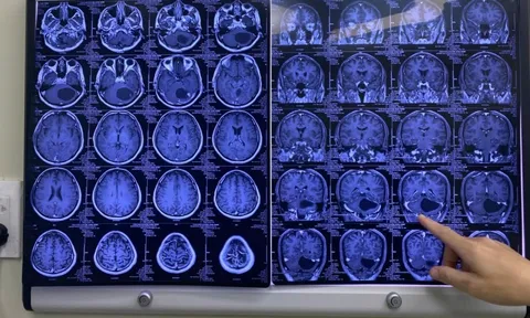 150 phút nghẹt thở với người đàn ông vào bệnh viện trong tình trạng đau đầu dữ dội