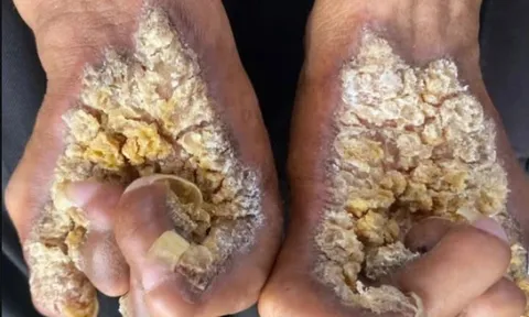 Người đàn ông thứ hai tại Việt Nam mắc hội chứng “người cây”