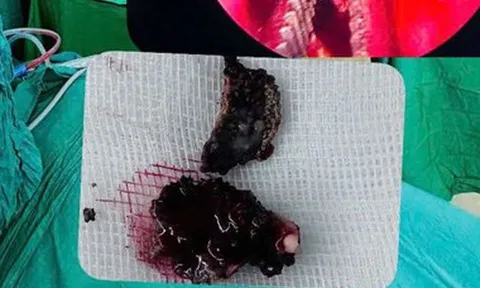 Chảy nước mũi hôi nhiều năm, bệnh nhân 23 tuổi đi khám bác sĩ gắp ra thứ "đáng sợ"