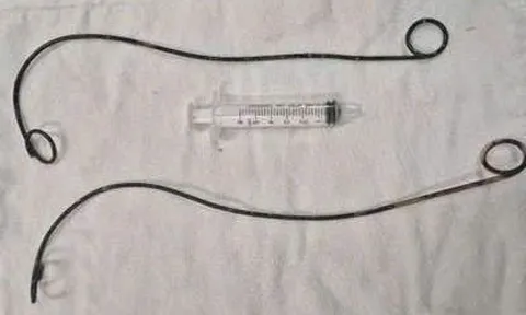 Bệnh nhân ở Cà Mau "bỏ quên" ống thông JJ trong người suốt hơn 10 năm