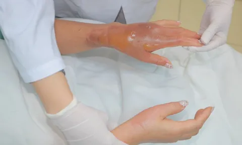 Bồn cầu phát nổ sau khi đổ hóa chất, người phụ nữ bỏng nặng