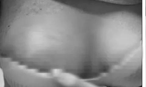 Hoại tử ngực vì tiêm chất làm đầy