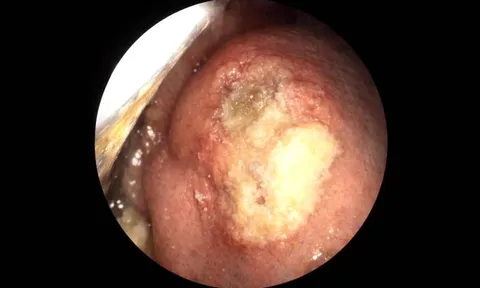 Vết loét nhỏ tưởng vô hại, hóa ung thư lưỡi