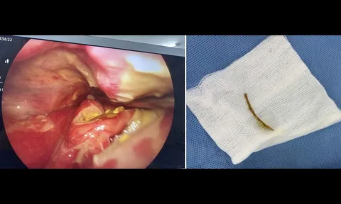 Ngậm viên sủi C để chữa hóc xương cá, người phụ nữ nguy kịch