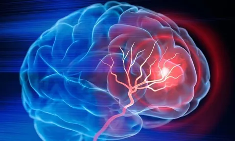 Mỹ phát triển phương pháp trị đột quỵ mới, chỉ cần 1 lần truyền dịch