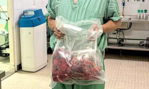 Lần đầu tiên tại Việt Nam: Cắt bỏ hai thận đa nang nặng gần 10kg, ghép thận thành công trong một ca mổ