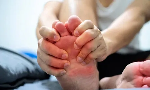 Làm sao để ngăn ngừa gout cấp tái phát?