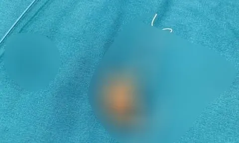 Người phụ nữ phát hiện sự thật sau 22 năm đặt vòng tránh thai