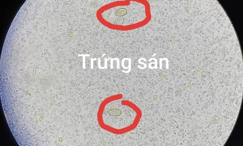 Đau bụng đi khám, người đàn ông 64 tuổi sốc ngang khi thấy ở sán trong người