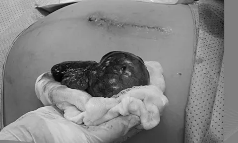 Thai 34 tuần, phát hiện u buồng trứng chèn ép