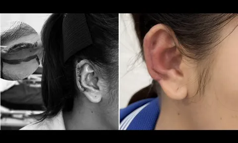 Tái tạo vành tai, trả lại dung mạo cho người phụ nữ trẻ bị tai nạn giao thông