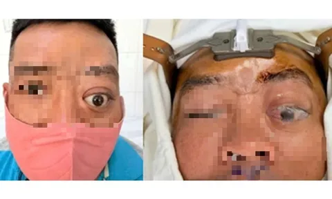 Một ca bệnh mà Bệnh viện Tai Mũi Họng TPHCM mới gặp lại trong vòng 20 năm