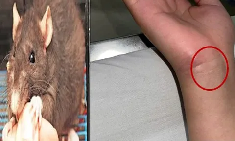 Nam sinh mắc bệnh nguy hiểm từ vết chuột cắn