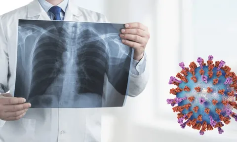 Viêm hô hấp cấp rình rập ngày Tết