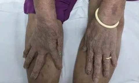 Tin vào thuốc lạ “uống thấy khỏe”, cụ ông 87 tuổi nhập viện trong tình trạng nguy kịch