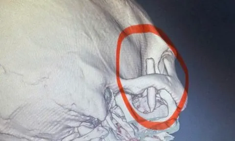 Chàng trai đau thái dương suốt 13 năm, bác sĩ phát hiện ra bí mật "đáng sợ" bên trong