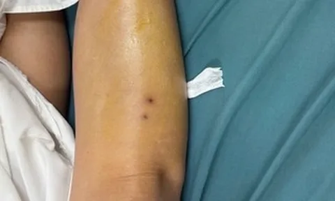 Tây Ninh: Phun thuốc cỏ, người phụ nữ bị rắn cắn nguy kịch