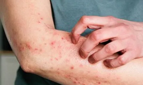 Bộ Y tế yêu cầu không để dịch bệnh viêm màng não mô cầu lan rộng tại cộng đồng