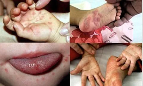 Sốt xuất huyết tăng 2,2 lần, tay chân miệng gấp 5 lần