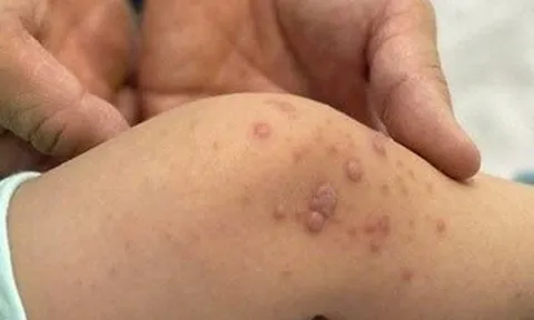 Bệnh tay chân miệng tăng nhanh, bác sĩ cảnh báo nóng