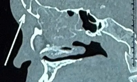 Tưởng chỉ viêm xoang đơn giản, nam thanh niên suýt mất mạng vì bị biến chứng