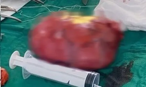 Đau bụng tưởng nhẹ, người phụ nữ sốc nặng khi bác sĩ lấy ra thứ “đáng sợ” trong bụng